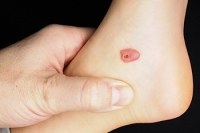 Definition and Causes of Foot Blood Blisters