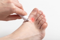 Causes of Athlete's Foot and Ways to Avoid It