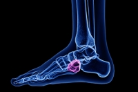 Cuboid Syndrome and Pain on the Outside of the Foot