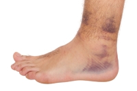 High Ankle Sprains in Athletes