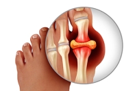 What Is Gout?