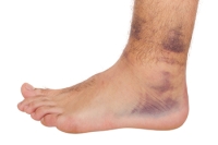 Causes of Ankle Bruises