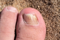 Understanding Toenail Fungus